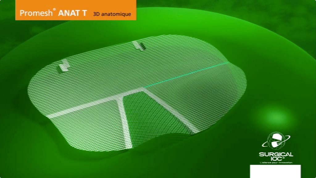 Agence Comete création Vidéo prothèse 3D : Motion design pour Surgical-IOC